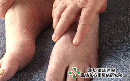 脚牛皮肤癣点状的症状图片
