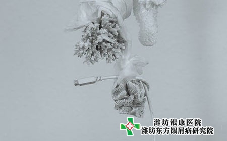 患上牛皮癣的原因有哪些?割耳放血管用吗?