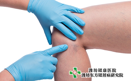 银屑病不同类型症状有哪些?治疗方法有哪些?