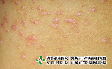 皮肤瘙痒警惕9种疾病图片