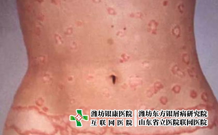 躯干斑块状牛皮癣
