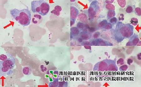 银屑病发病原因