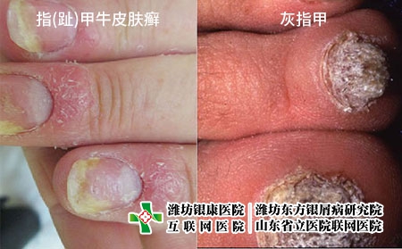 指(趾)甲牛皮肤癣和灰指甲的发病原因|图片症状|治疗方法的区分