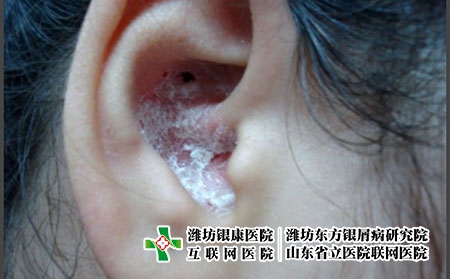 耳朵银屑病-治疗耳部银屑癣的药