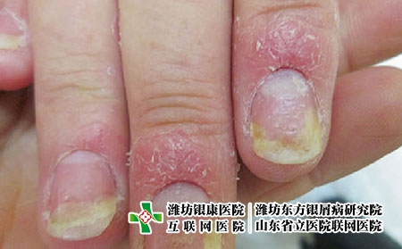 指甲银皮癣图片的症状