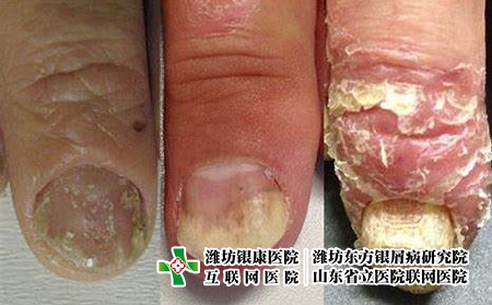 指甲牛皮肤癣病变过程
