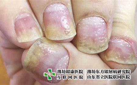 指甲牛皮肤癣病变的症状图片