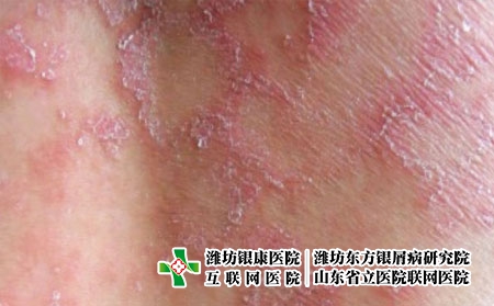 牛皮肤癣和玫瑰糠疹的区别有什么