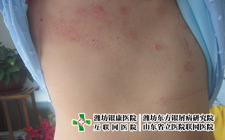 中国宣布取消新冠免费治疗，男女牛皮癣的危害
