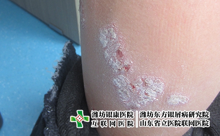 防疫药物该买什么?潍坊关节型牛皮癣的发病原因是什么