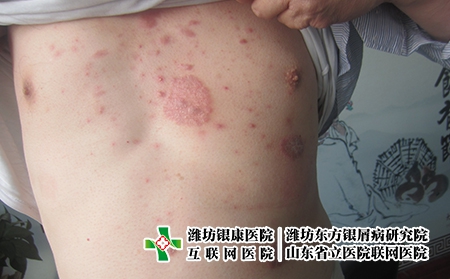 什么样的人容易复阳?潍坊牛皮癣是怎么回事
