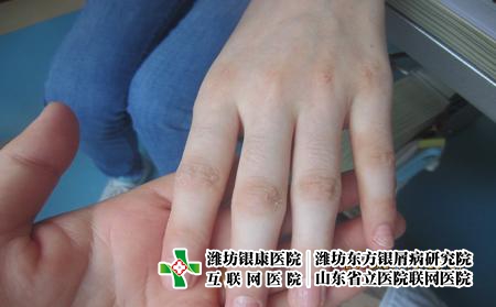 潍坊得了牛皮癣怎么办?潍坊哪所牛皮癣医院好