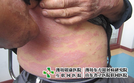 潍坊治疗牛皮癣医院在哪里?潍坊哪个医院治牛皮癣比较好
