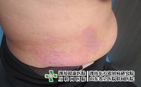 因素导致牛皮癣困扰自己?潍坊牛皮癣哪个医院治得好