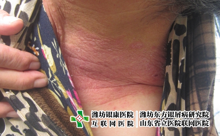 潍坊哪家医院治疗牛皮癣比较专业，潍坊银屑病推举东方