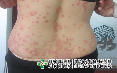 潍坊诱发牛皮癣的关键因素都有哪些?潍坊牛皮癣哪家医院好