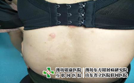 潍坊得了牛皮藓该怎么办，山东银屑病不错潍坊东方