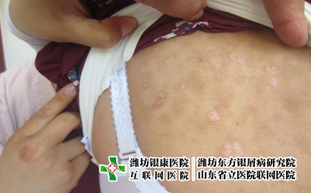 潍坊医院治疗牛皮癣大概需要花费多少钱，青岛银屑病赞美潍坊东方