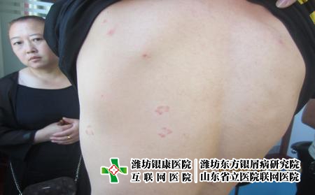 潍坊什么因素会导致牛皮癣再次发作?
