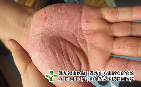 掌跖脓疱病初期图片-掌跖脓疱病图片-掌跖脓疱病的症状