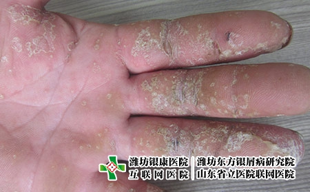 手掌脓疱病图片-手掌脓疱病的症状-手掌有脓疱型银屑病