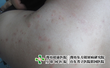 潍坊治疗牛皮癣好的医院去哪，牛皮癣治疗哪个医院好