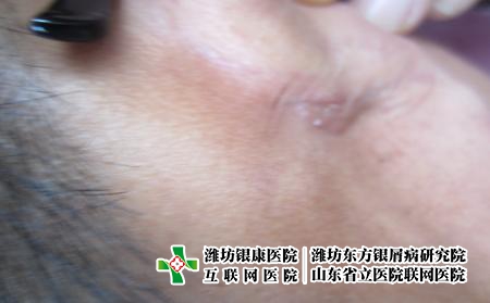 潍坊牛皮癣老不好很痛苦怎么办，顽固牛皮癣怎么治