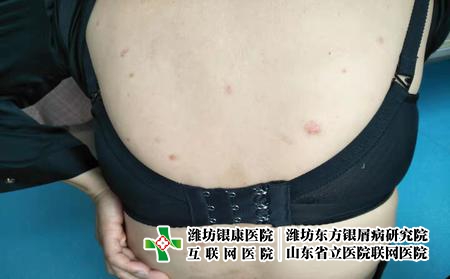 潍坊牛皮癣同形反应是怎么回事，牛皮癣为什么会扩大