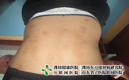 牛皮癣不同时期怎么治，潍坊东方怎么治牛皮癣