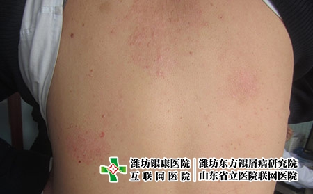 血热型牛皮癣是怎么回事，牛皮癣怎么治