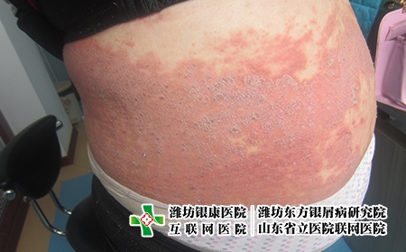 潍坊治疗牛皮癣的医院哪家正规，潍坊东方好不好