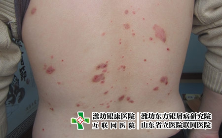 潍坊牛皮癣医院哪个好呢，潍坊东方水平怎么样
