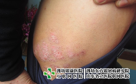 牛皮癣有什么类型，牛皮癣有哪几种