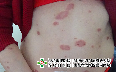 牛皮癣患者可以化妆吗，女性牛皮癣患者能用化妆品吗