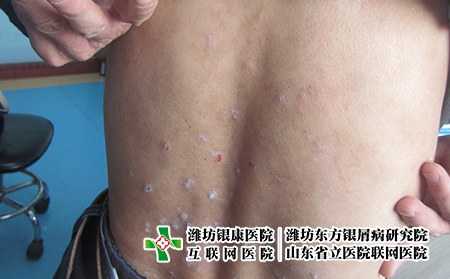 寻常型牛皮癣出现该如何治，牛皮癣怎么好得快