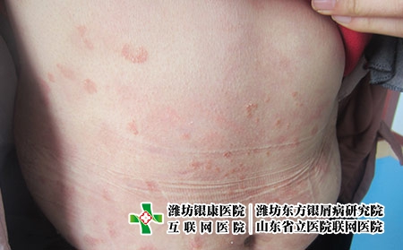 山东治疗牛皮癣好的医院在哪?潍坊东方医院看牛皮癣好