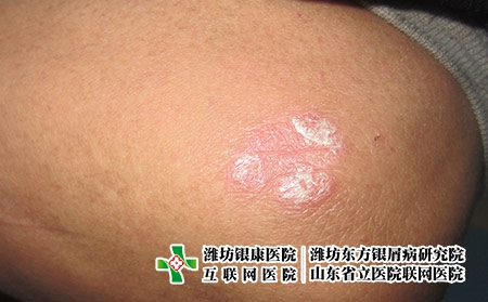 潍坊看牛皮癣的医院哪家好，潍坊东方专业专注