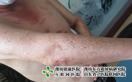 牛皮癣关节炎是怎么回事，牛皮癣会导致关节炎吗