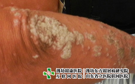 每天泡澡对牛皮癣好吗，牛皮癣怎么洗浴