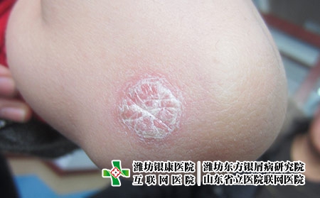 预防牛皮癣复发的原则，怎么避免牛皮癣的反复