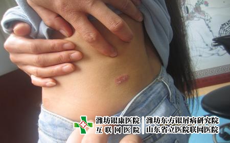 潍坊治疗牛皮癣哪家医院比较不错，潍坊东方优势