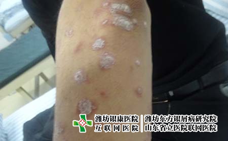 牛皮癣患者需要进行哪些检查，潍坊东方治银屑病前期检查
