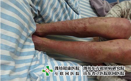 如何治疗女性腿部银屑病，牛皮癣怎么治疗好