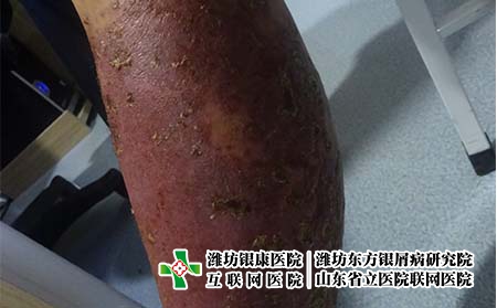 银屑病的病因有哪些，生活中什么会导致牛皮癣