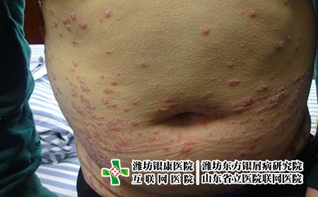 如何正确的认识银屑病，牛皮癣是怎么回事