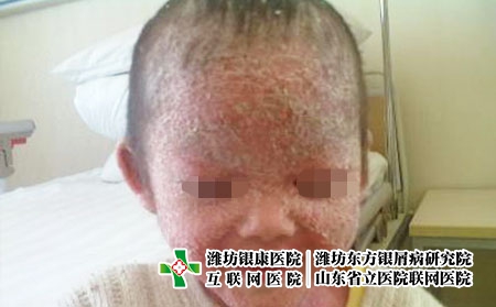 潍坊都有哪些好的牛皮癣医院，山东哪家银屑病医院好
