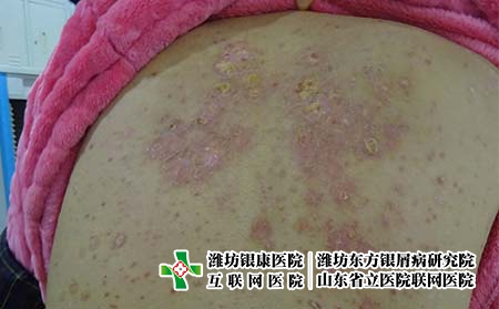 银屑病的症状图片和治疗?牛皮癣是怎么回事
