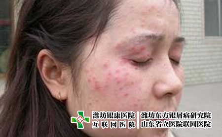 银屑病要怎么治疗，牛皮癣如何用药