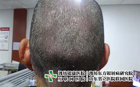 头皮牛皮癣会出现哪些症状，头上会长银屑病吗