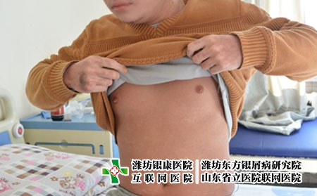 牛皮癣患者吃什么食物可以防晒，潍坊东方银屑病研究院评价